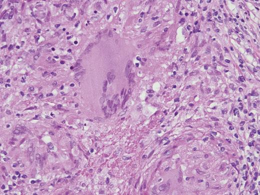 Core biopsy of the liver showing granuloma with Langhans giant cells.