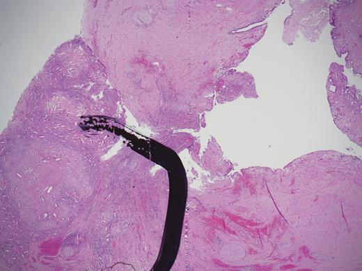 Intramural granuloma in the CBD.