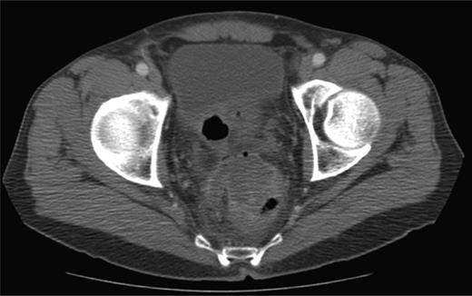 CT scan depicting perirectal stranding without definite abscess formation.
