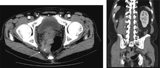 (a) Repeat CT at 6 weeks showing supralevator abscess formation (white asterisk). The levator ani muscle is illustrated by white arrow (b) coronal image of complex supralevator collection. Arrow points to the levator ani muscle.