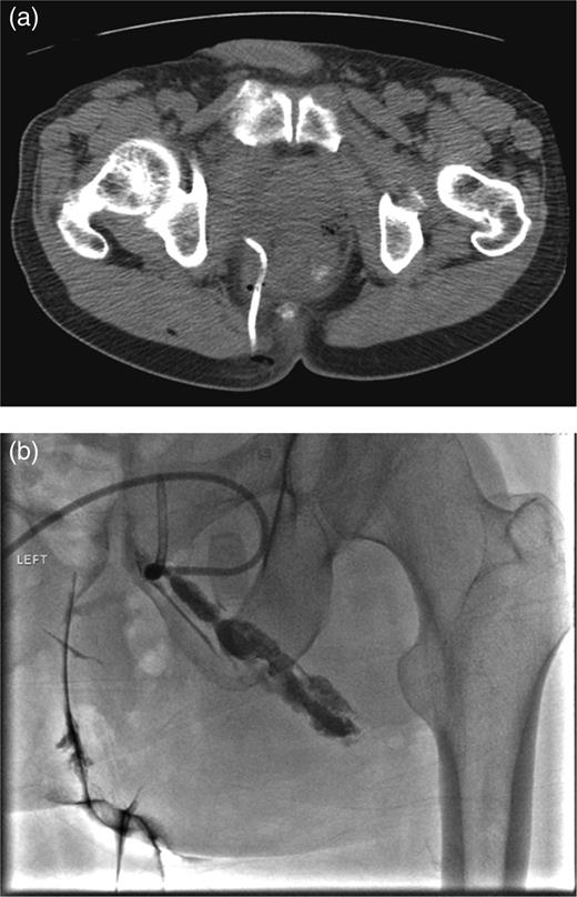 (a) CT-guided percutaneous drainage of perirectal abscess (b) fluoroscopic drain study showing contrast extending into the supralevator space.
