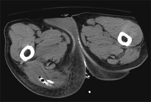 CT scan demonstrating ischiorectal extension of oral contrast and air tracking.