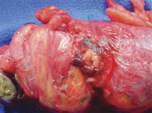 Intraoperative specimen. Sigmoid colon, etc colon with single perforated diverticulum separated from the right pelvic sidewall at the site of fistulization.