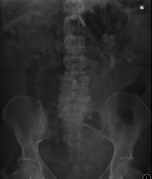 X-ray showing large left-sided stag horn calculus, with a second adjacent fragment outside the renal parenchyma with evidence of bowel obstruction.