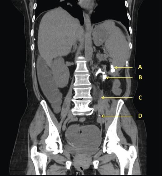 CT scan showing (A) Extra-renal fragment of calculus adjacent to transition point in thickened descending colon. (B) Staghorn calculus within atrophic left kidney with surrounding inflammation. (C) Thickened inflamed psoas muscle. (D) Fragments of calculus in LIF.