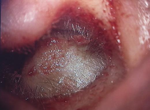 EAC osteoma.