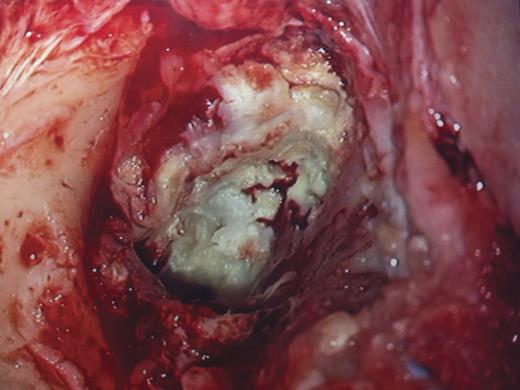 EAC cholesteatoma with inferior canal wall erosion.