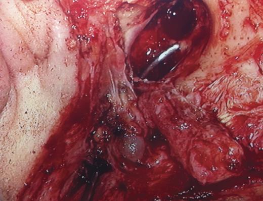 Fistula defined by probe from EAC to upper neck.