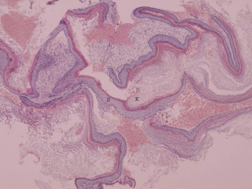 Photomicrograph of cholesteatoma showing stratified squamous epithelium (S) and overlying lamellar sheets of keratin (K) (H&E ×10).
