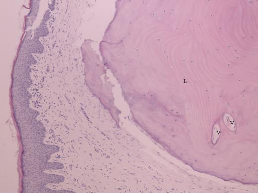 Photomicrograph of osteoma within the skin of external auditory canal showing lamellar bone (L) and fibrovascular channel (V) (H&E ×20).