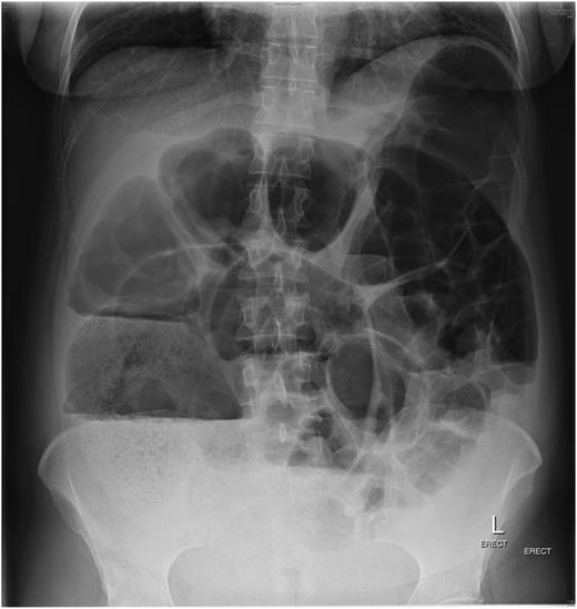 Plain abdominal X-ray consistent with pseudo-obstruction.