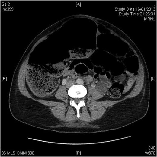 CT scan of the abdomen showing caecum measuring 9.8 cm transversely.