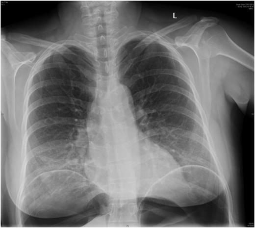 Erect chest X-ray confirming perforated visus.
