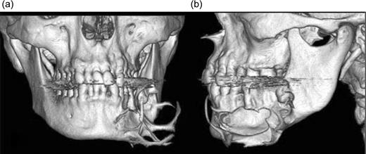 Frontal view of pre-operatory 3D CT images shows the destruction of bone and a spiculars osseous formation (a) and in lateral view show the destruction of the cortex (b).