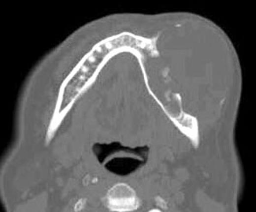 Preoperative axial CT view shows the lesion with destruction the medullar and buccal cortical portions of the left mandible.