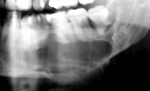 The panoramic radiography shows a large radiolucent and well-defined lesion with a radiopaque corticates margin involving the left mandibular premolar and molar area.