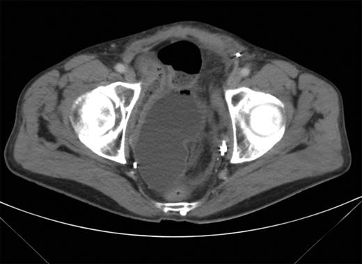 CT scan showing transition point of dilated bowel lying adjacent to the neobladder.