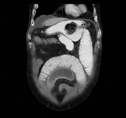 Contrast-enhanced abdominal CT scan in coronal view showing evidence of gastrojejunostomy and visible foreign body in the stomach and features of small bowel obstruction.