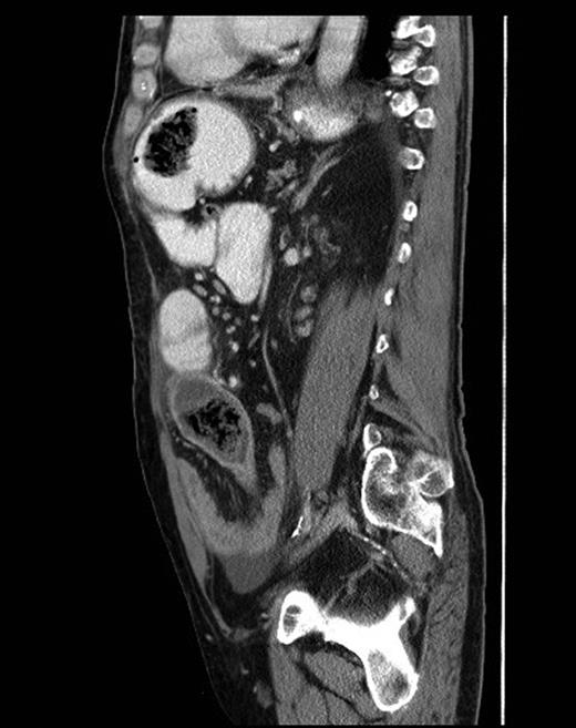 Sagittal CT scan view showing foreign bodies in the stomach and the ileum with transition point in the small bowel.