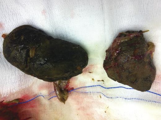 Retrieved phytobezoars.