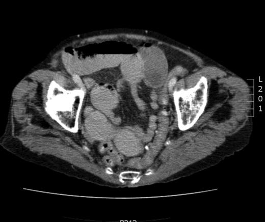 CT image. Proximal small bowel obstruction secondary to a left obturator hernia within white outline.