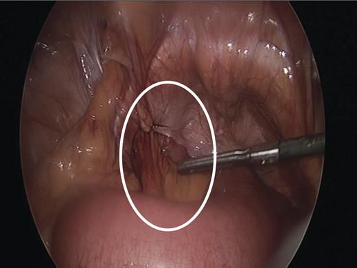 Intraoperative image showing left sided obturator hernia within white outline and incidental femoral hernia at 11’o clock position.