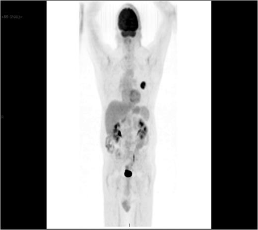 PET CT showing left lingular malignancy and no evidence of metastasis.