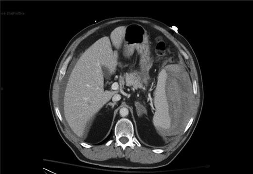 Atraumatic splenic rupture with hemoperitoneum.