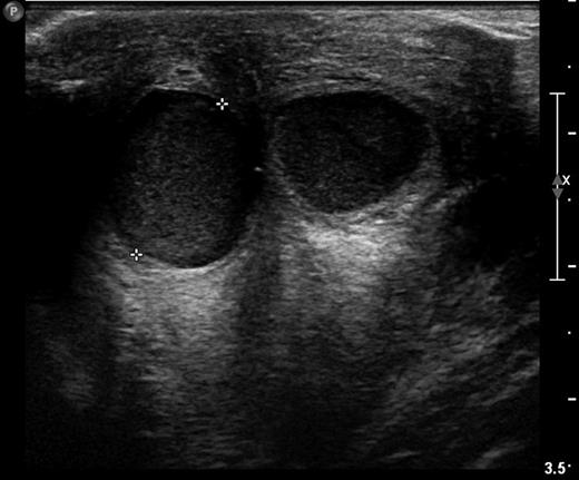 Retroareolar cysts in ultrasonography of the breast.