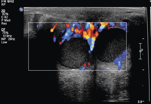 Infected retroareolar cyst with increased peripheral flow.