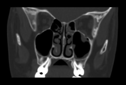 Preoperative CT scan showing a fracture of the left orbital floor with entrapment of the inferior rectus muscle.