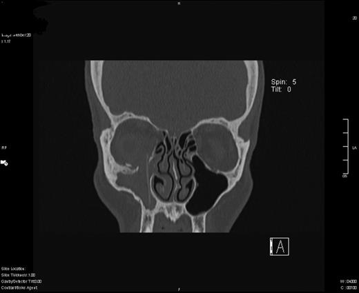 Coronal slice of CT scan demonstrating silastic sheet protruding through the right orbital floor.