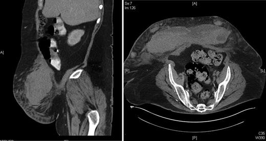 CT abdomen of a 59-year-old obese female with an abdominal wall haematoma.