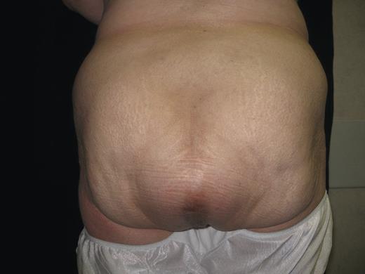 Posterior view of the patient upon initial presentation. There is a large bulging area where the APR was performed. The hernia was soft and reducible.