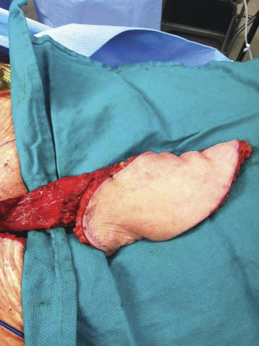 Intra-operative photo of VRAM harvest.