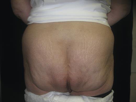 One-year post-operative posterior view of the patient. The hernia repair is intact and the patient is symptom free.