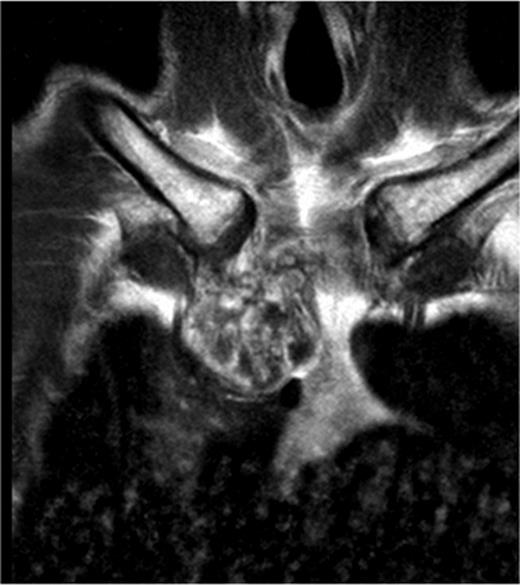 A MRI scan of a patient showing a tumour involving the manubrium extended to the first and second ribs including the right clavicle and sternoclavicular joint.