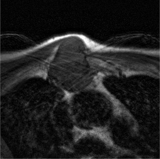 The axillar slides of the MRI of the patient showing the ingrowth of the tumour in the thoracic cavity in relation to the intrathoracic organs.
