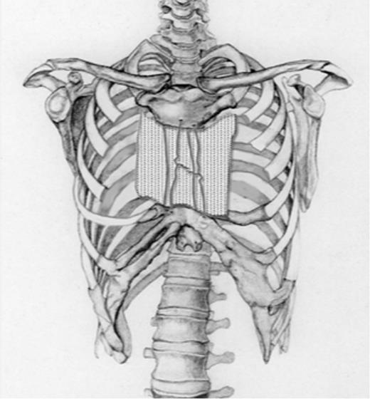 Schematic drawing of the size of the defect after radical excision followed by placing steel wires through the stenal ends.