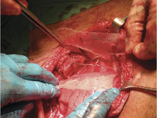 This picture shows the size of the defect in the patient after radical resection, which was 6.5 centimetres. Consequently, steel wires were placed through the sternal ends and the left sternoclavicular joint and a polypropylene mesh was place on the surface of the defect.