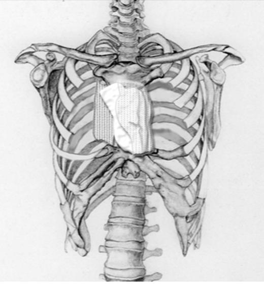 Schematic drawing showing a polypropylene mesh filled with methyl methacrylate composite to reconstruct the sternal defect.