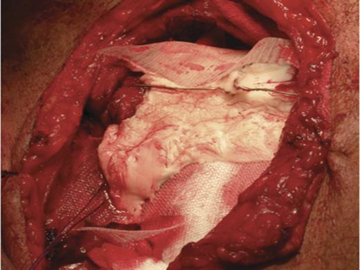 Around these steel wires a polypropylene mesh was placed filled with methyl methacrylate composite to reconstruct the sternal defect.