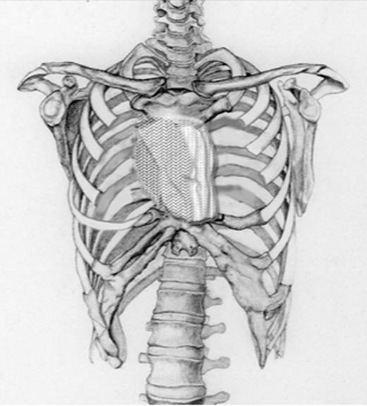 Schematic drawing showing the final reconstruct after tumour resection of the sternum.