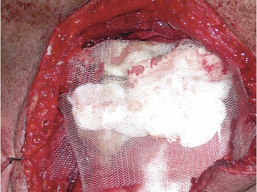 This picture shows the final reconstruct after tumour resection of the sternum in the patient.