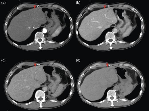 CT scan.
