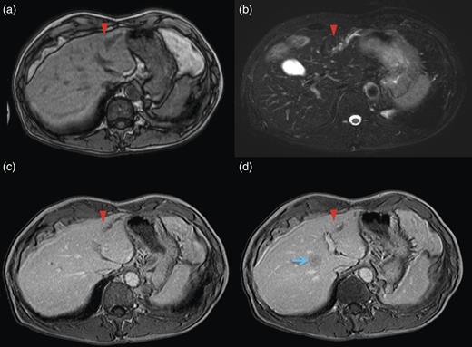 MRI scan.