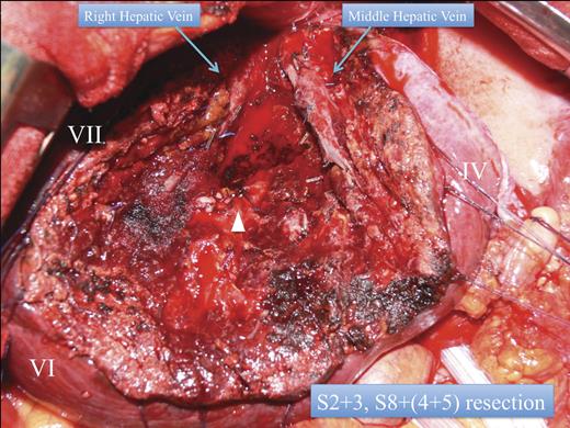 Anatomic lateral segmentectomy, and S8 segmentectomy. White arrow head: the right pedicle.