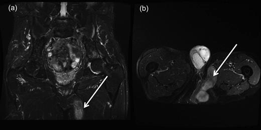 (a and b) Coronal and transverse magnetic resonance imaging scans demonstrating perineal hernia extending into the left thigh. (Demonstrated by white arrows.)