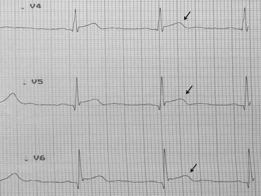 EKG showed changes suggestive of transmural lesion.