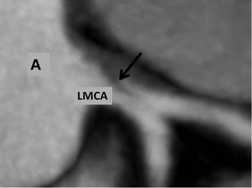 Multidetector coronary angio-tomography reveals dissection at the ostium of the left main coronary artery. A, aorta; LMCA, left main coronary artery; arrow, dissection.